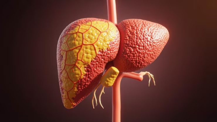 Fatty Liver Disease: Causes, Symptoms, Treatment and How to Reverse It
